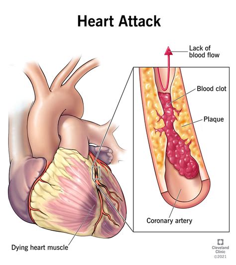 Heart Attack: Symptoms, Causes and Recovery (2022)