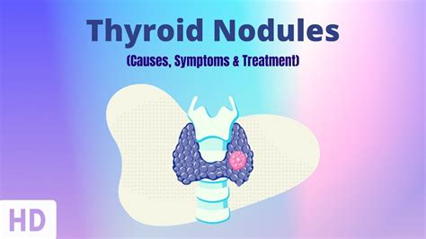 Thyroid Nodules: Causes, Symptoms and Treatment - YouTube