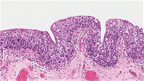 Urothelial Carcinoma Pathology Outlines