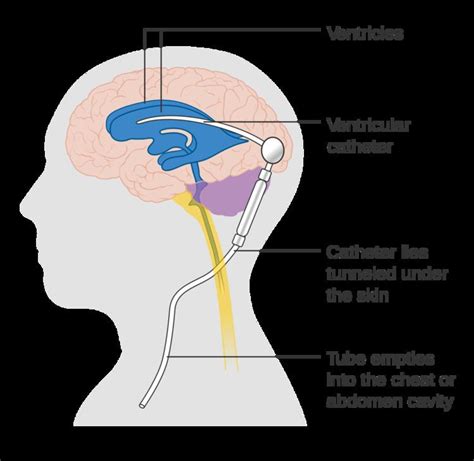 Cerebral shunt - Alchetron, The Free Social Encyclopedia