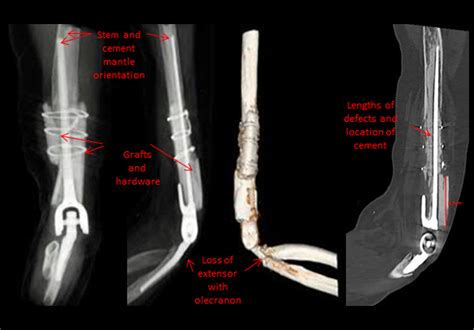 Challenging elbow revisions: total elbow arthroplasty with massive bone ...