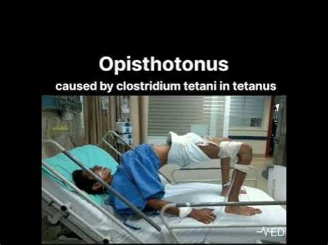 Opisthotonus caused by clostridium tetani in tetanus#doctor#viral # ...