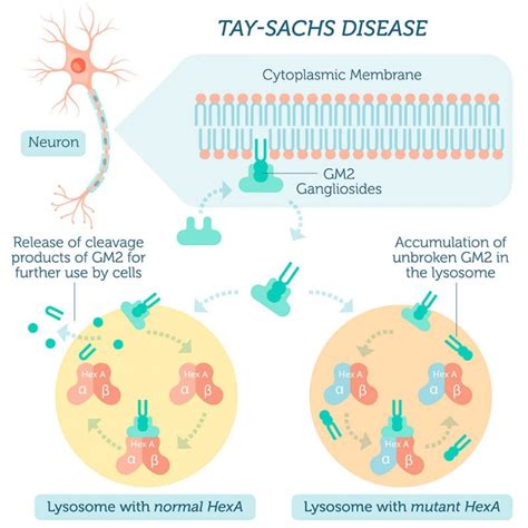 Tay Sachs Disease Symptoms, Causes, Treatment NORD, 45% OFF