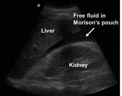 Ectopic Pregnancy – Core EM