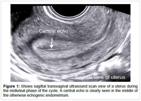 Endometrial Phases Ultrasound