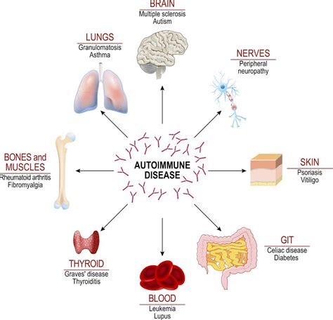 An autoimmune-like antibody response is linked with severe COVID-19 - Attention to the Unseen