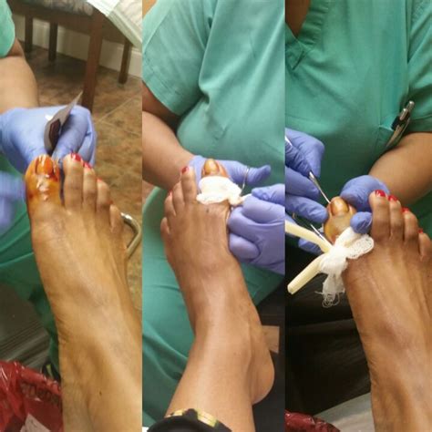 If You Struggle With Ingrown Toe Nails, Consider a Matrixectomy - Rx ...