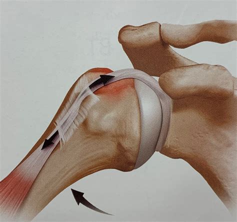 Biceps Tenodesis | Shoulder Injuries | Dr. Christopher Ahmad