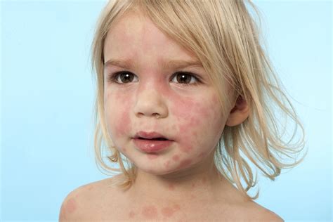 Red Rash Around Mouth And Eyes Child | Allergy Trigger