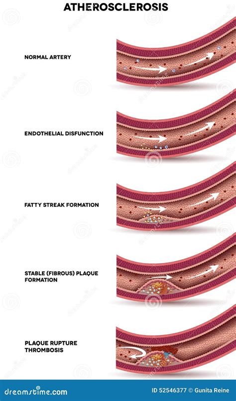 Atherosclerosis Stages Stock Vector - Image: 52546377