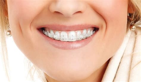 Sapphire braces - S.I.Y. Dental