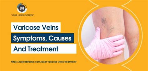 Varicose Veins: Symptoms, Causes, and Treatment – Laser360clinic.com