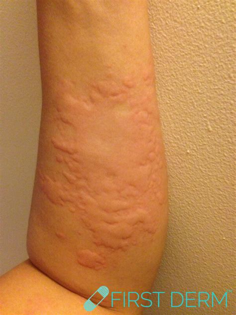 Skin Rash: Pictures, causes and treatment