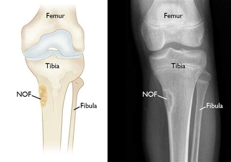 Nonossifying Fibroma - OrthoInfo - AAOS