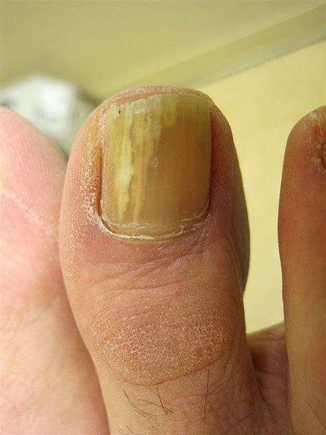 Yellow toenails and diabetes - Awesome Nail