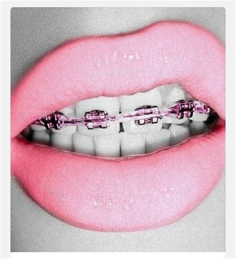 Pink Dental Braces, Teeth Braces, Braces Smile, Adult Braces, Pink ...