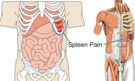 Spleen Pain - Location, Function, Enlarged and Ruptured spleen