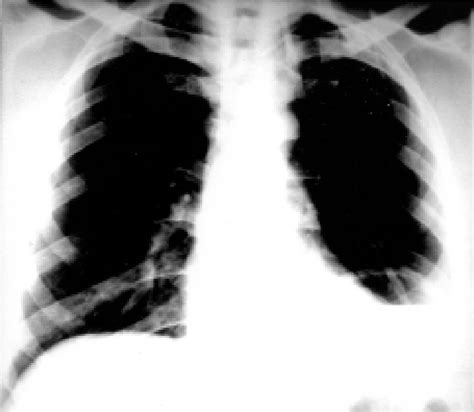 Chest X-ray shows elevated left diaphragm and minimal pleural effusion. | Download Scientific ...