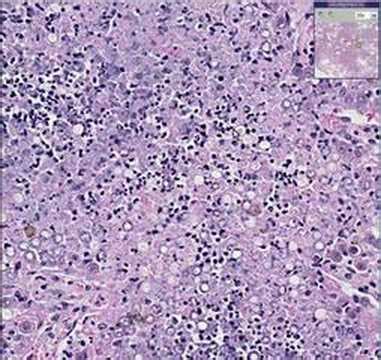 Histopathology Lung--Blastomycosis - YouTube