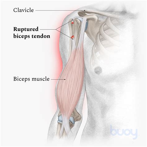 Biceps And Brachioradialis Anatomy 3d Medical Vector Illustration On White Background Stock ...