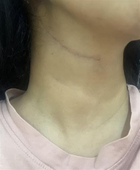 5 month old neck dissection scar from lymph node removal. : r/scars