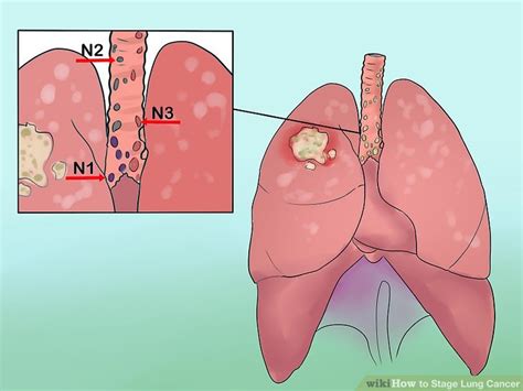 How to Stage Lung Cancer (with Pictures) - wikiHow