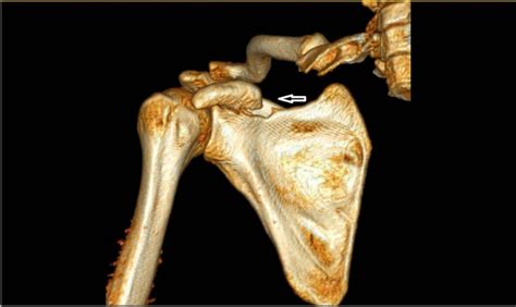 An Isolated Displaced Fracture of the Coracoid Process Treated with Osteosynthesis—A Case Report ...