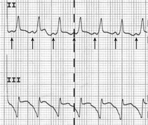 Wide Qrs Complex Tachycardia