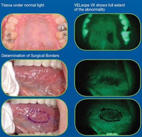 Oral Cancer Screening - Bayview Village Dental - North York, Willowdale