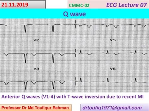 ECG-Q wave