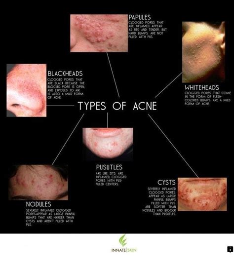 Our web images are a must see!! | Types of acne, Skin care acne, Skin treatments