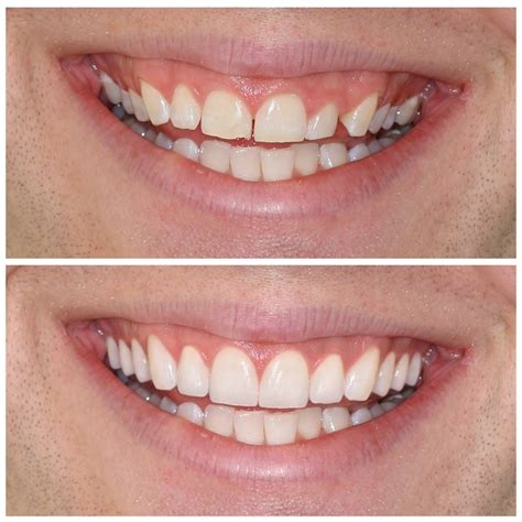 Gum Contouring NYC - Gum Reshaping New York | 209 NYC Dental Office