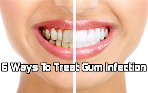 6 Ways To Treat Gum Infection - Pymble Dentist