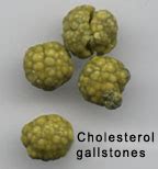 Gallstones - wikiRadiography