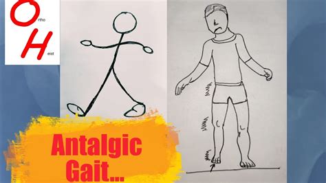 Antalgic gait - YouTube