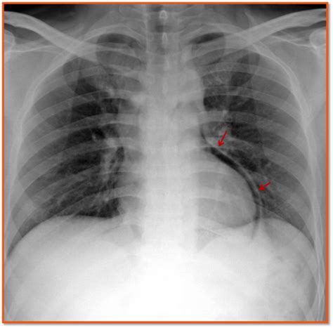 Pneumopericardium - radRounds Radiology Network