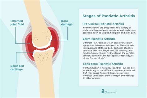 Stages of Psoriatic Arthritis: Signs of Early to Late Disease Progression