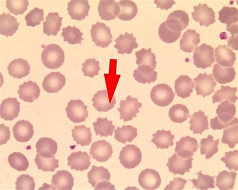 Pyruvate Kinase Deficiency - Hematology - Medbullets Step 1