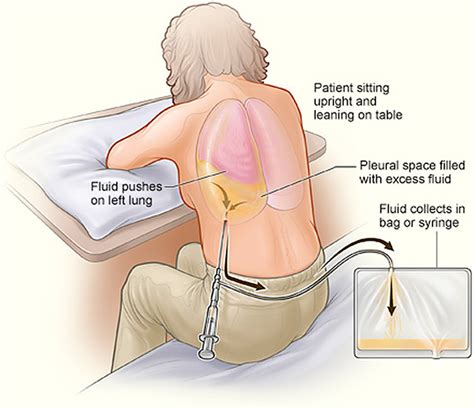 Figure 1 from Centesis studies in critical care. | Semantic Scholar