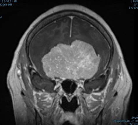 Case Study: Giant Olfactory Groove Meningioma - Briz Brain & Spine