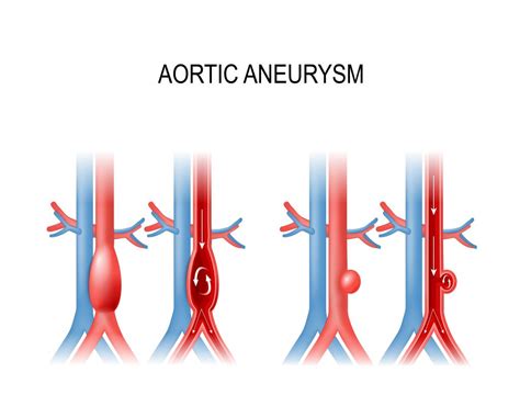 Recommendations for Abdominal Aortic Aneurysm Screening - AAPC ...