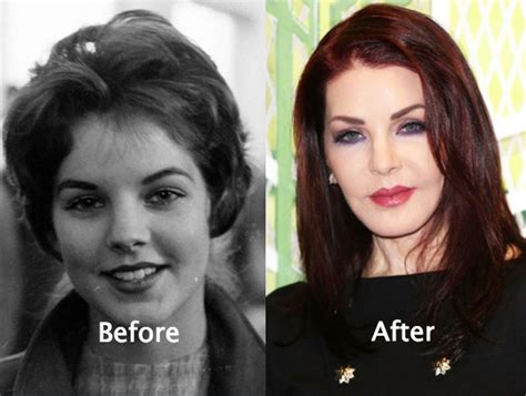 53 Celebrity Plastic Surgery Gone Wrong With Photos