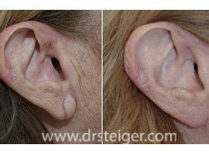 split earlobes 1 | Steiger Facial Plastic Surgery | Boca Raton Facelift, Rhinoplasty, Eyelid ...