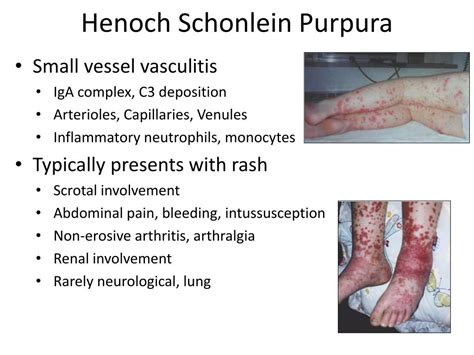 Henoch Schonlein Purpura Arthritis