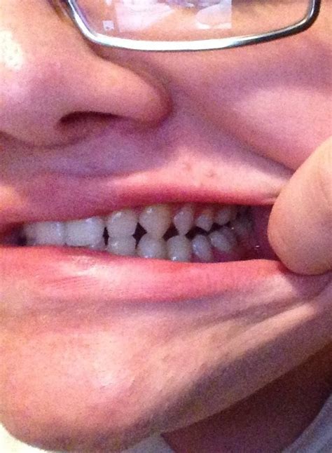 My teeth are unusually sharp : r/mildlyinteresting