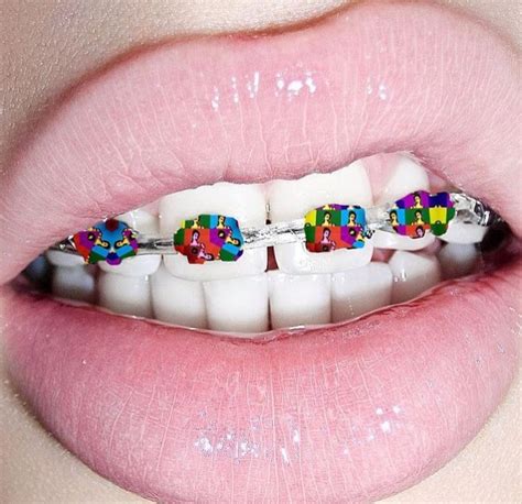 31+ Braces color ideas for yellow teeth ideas | jayamahes