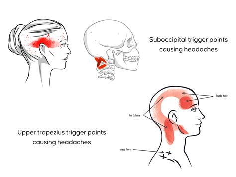 Tightness at the base of the skull? Massage these muscles