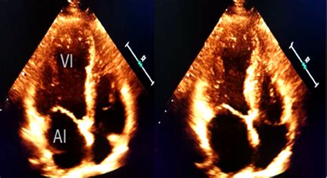 Figure 2. Echocardiogram in apical four-chamber view during the phases ...