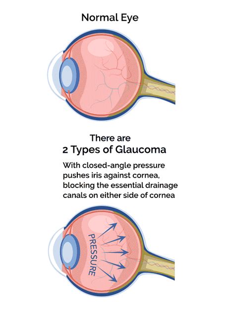 Glaucoma Eye Exam in Dunedin | AccuVision Optical