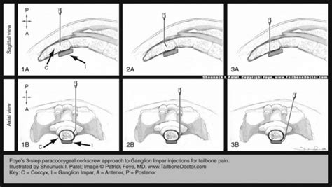 Ganglion Impar Injection | Radiology Key